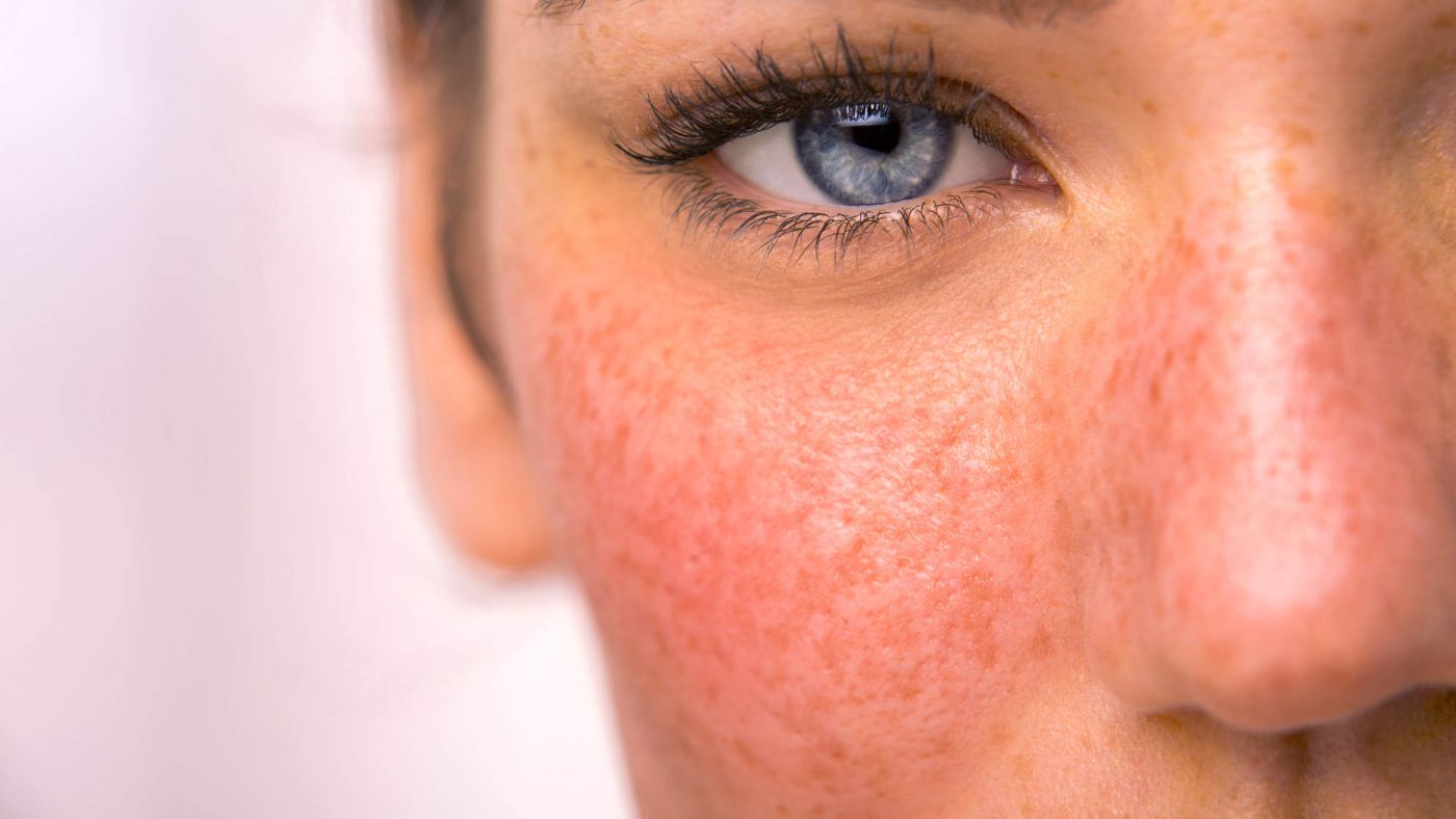 حساسیت پوستی چیست و دلایل آن - بیماری های پوست - دکتر احسانی
